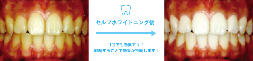 �Z���t�z���C�g�j���O��1��ł����ʃA���I�p�����邱�ƂŌ��ʂ��������܂��I